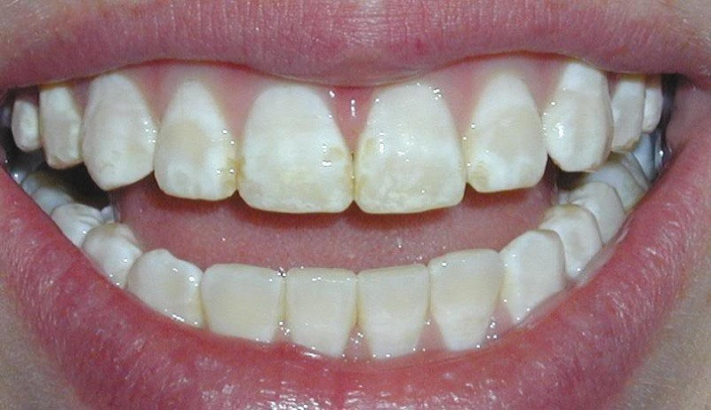 Hư men răng có thể gây nên nhiều bệnh lý như: Đau răng, sâu răng, răng nhạy cảm,...