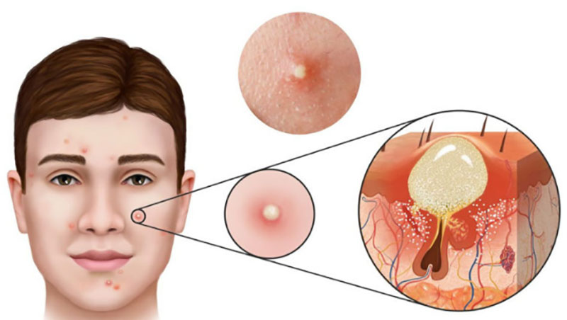 Tiếp xúc nước có lượng Flo cao có thể khiến da bị kích ứng, nổi mụn trứng cá